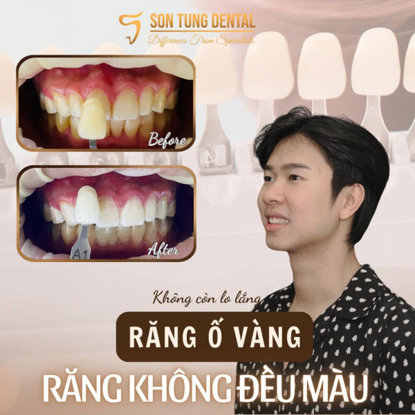 LÀM TRẮNG RĂNG CHO NGƯỜI HÚT THUỐC?