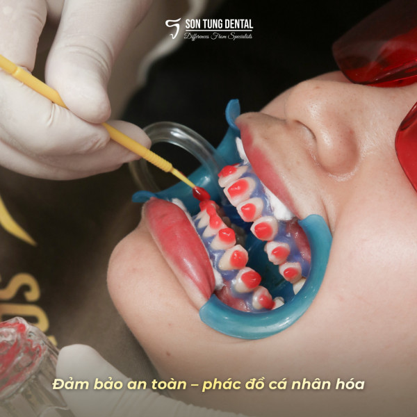 Làm trắng răng giá bao nhiêu?