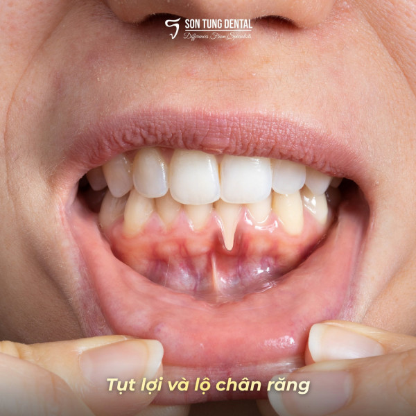 Tiêu xương hàm là gì