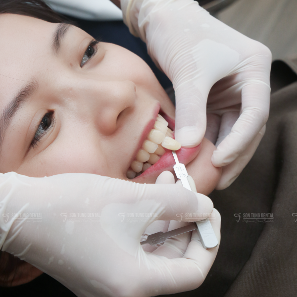 Làm trắng răng giữ được bao lâu