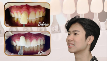 Làm trắng răng cho người hút thuốc