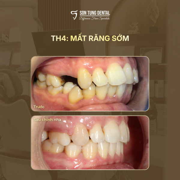Mất răng ảnh hưởng tới khuôn mặt như thế nào?