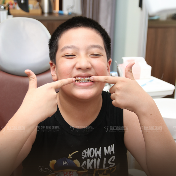 Trẻ bị hô có nên niềng sớm không?