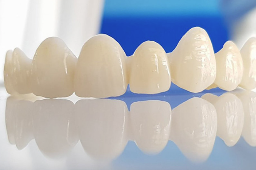 Răng sứ Cercon là gì? Ưu điểm, giá và độ bền tại Nha khoa Sơn Tùng