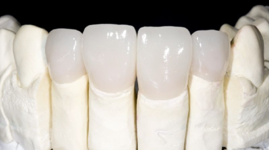 Răng sứ zirconia là gì? Giá bao nhiêu? Có nên bọc