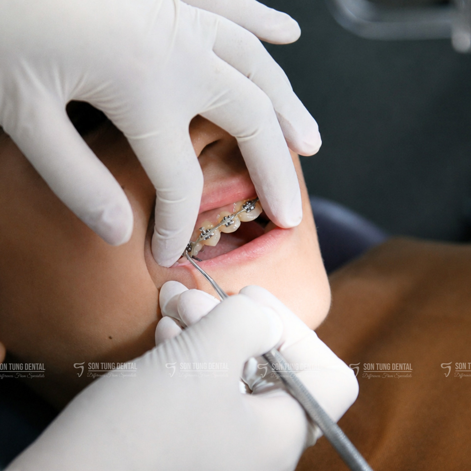 niềng răng trẻ em