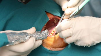 Trồng răng implant toàn hàm