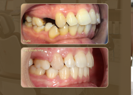 Mất răng ảnh hưởng như thế nào?