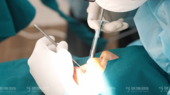 Trồng răng implant hiện nay là giải pháp tối ưu cho người bị mất răng hiện nay
