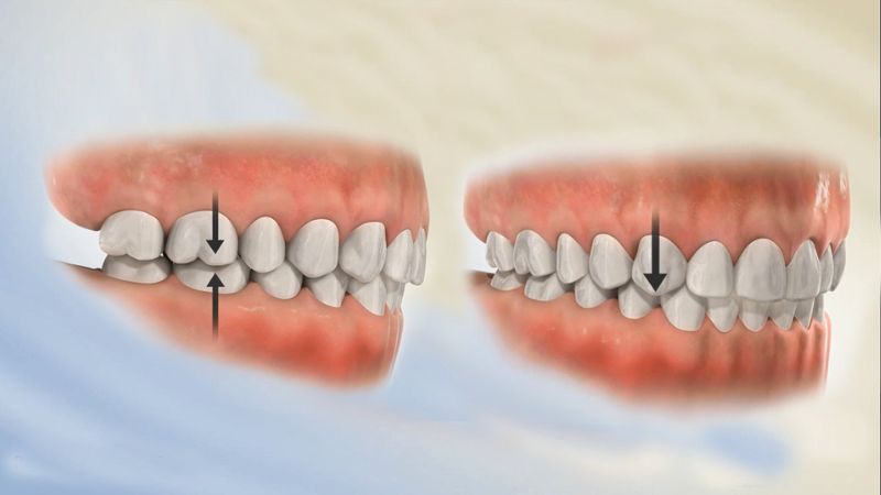 Khớp cắn ngược là triệu chứng thường gặp ở trẻ em hiện nay
